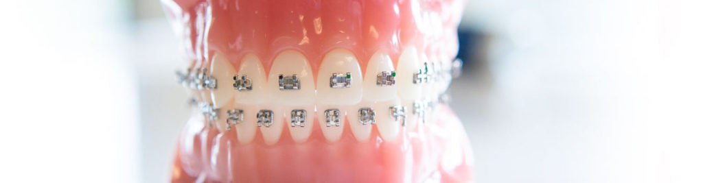 tcv-slider-orthodontie